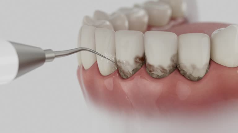 Trusted Wisdom Tooth Removal service in Cadott, WI - Dentist Open Now